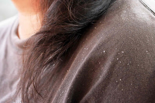 dandruff remedy