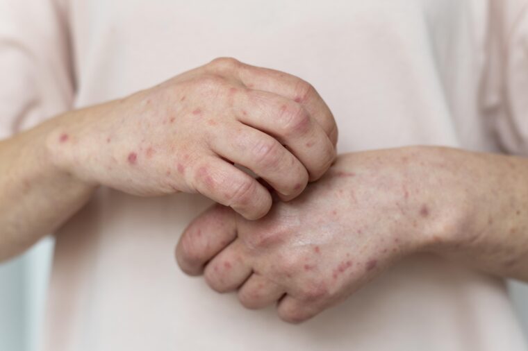 Rosacea